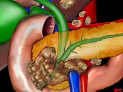 我国胰腺癌发病率逐年递增